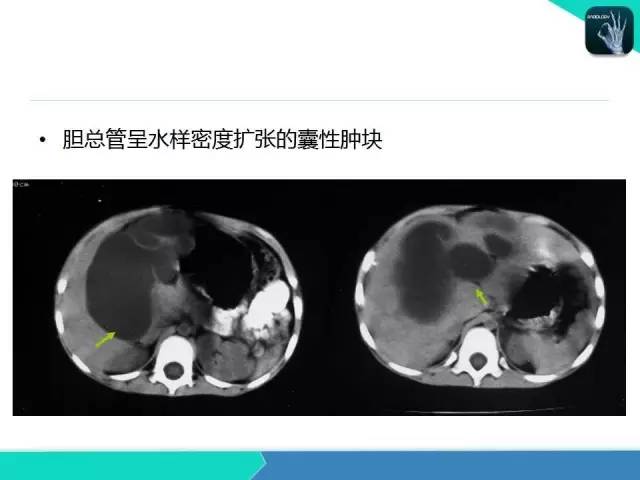 【PPT】胆道系统影像诊断