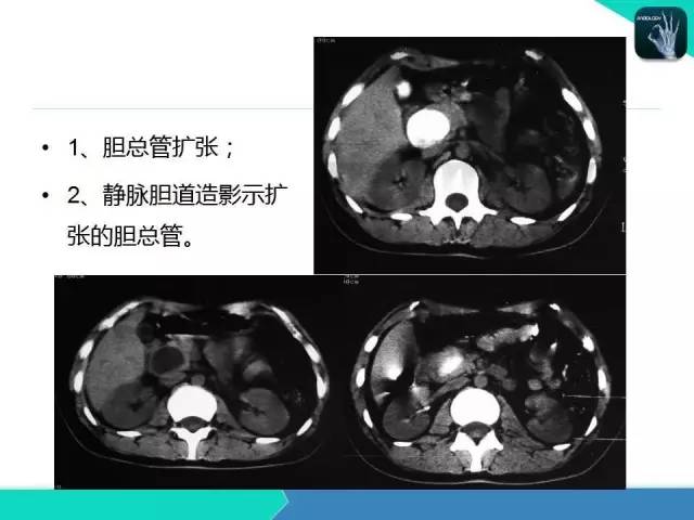 【PPT】胆道系统影像诊断