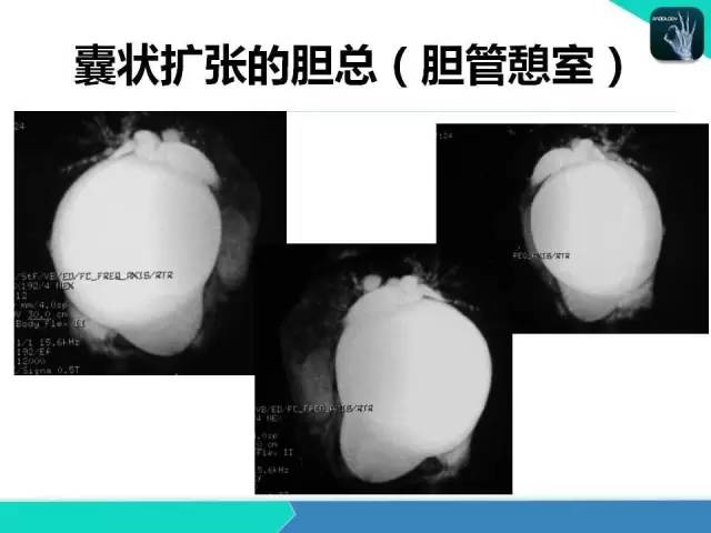 【PPT】胆道系统影像诊断
