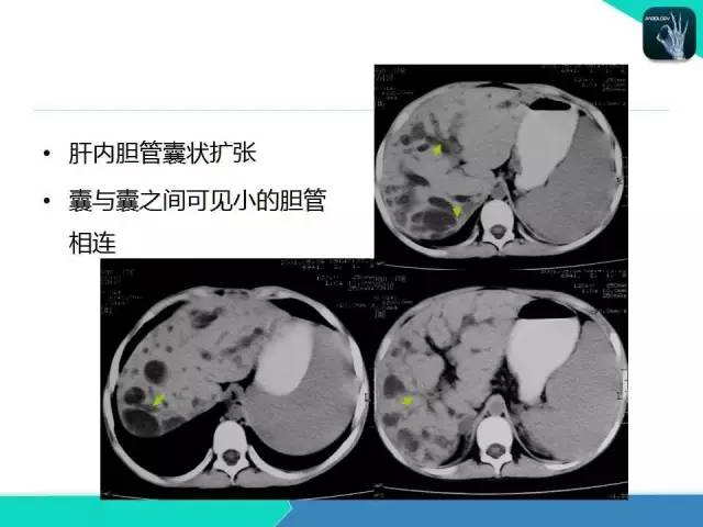 【PPT】胆道系统影像诊断