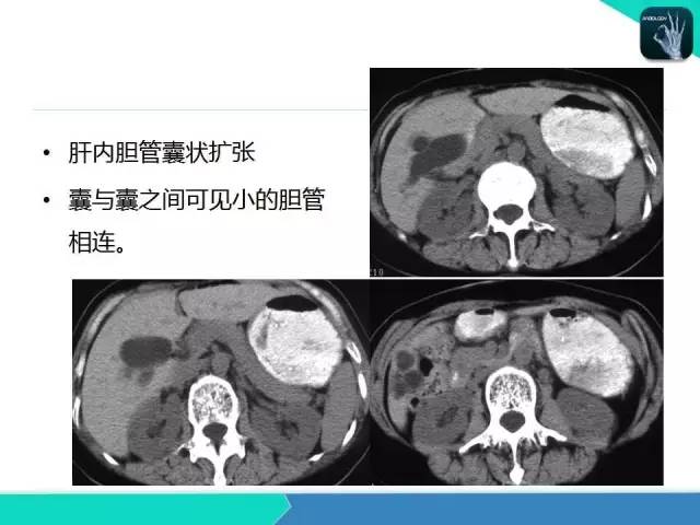 【PPT】胆道系统影像诊断