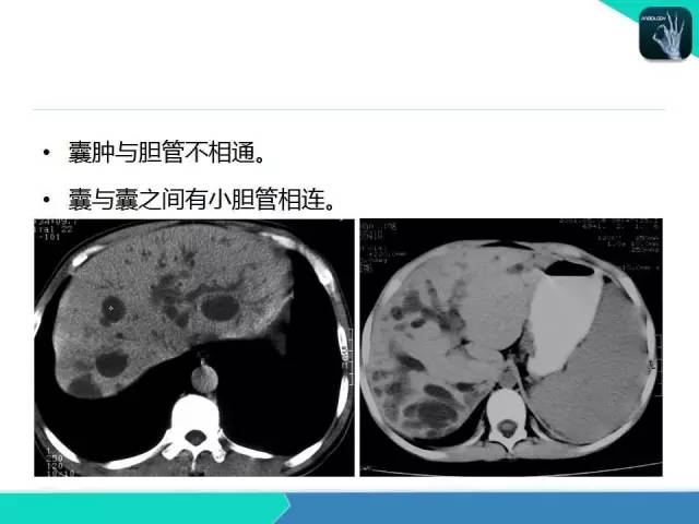 【PPT】胆道系统影像诊断