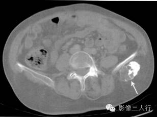 "菜花征"，这个征象提示啥？