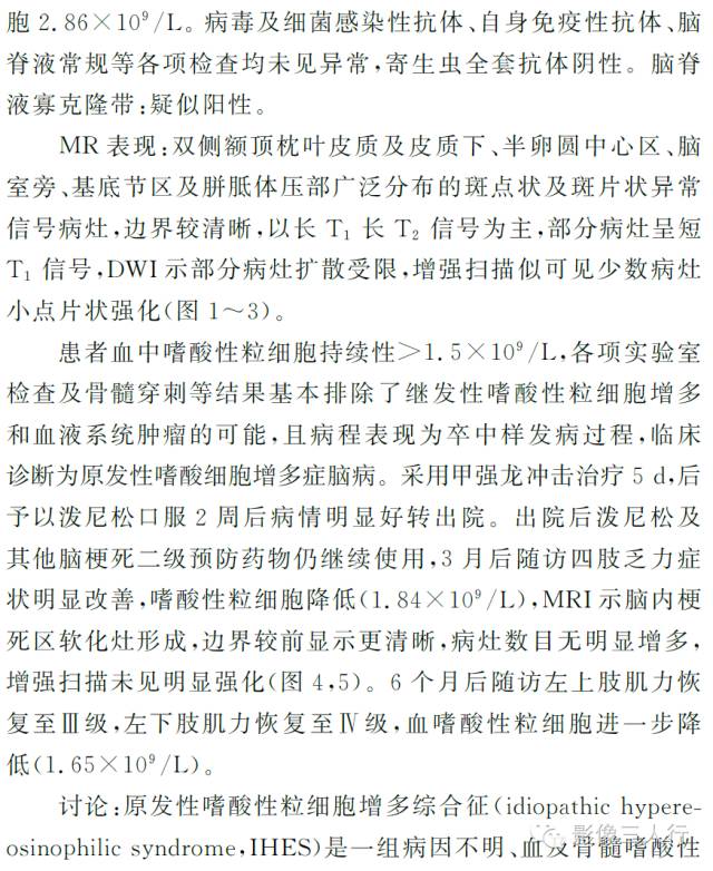 【病例】原发性嗜酸性粒细胞增多综合征脑病1例MR