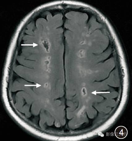 【病例】原发性嗜酸性粒细胞增多综合征脑病1例MR