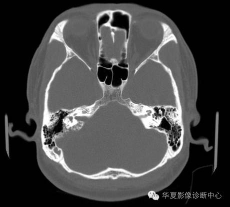 【病例】乳头状内淋巴囊腺瘤1例CT影像表现 【病例】乳头状内淋巴囊腺瘤1例CT影像表现