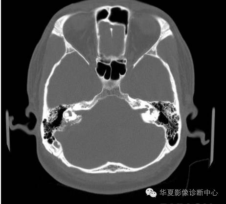 【病例】乳头状内淋巴囊腺瘤1例CT影像表现 【病例】乳头状内淋巴囊腺瘤1例CT影像表现