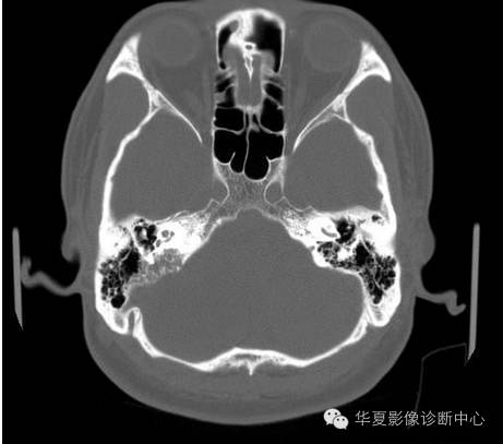 【病例】乳头状内淋巴囊腺瘤1例CT影像表现 【病例】乳头状内淋巴囊腺瘤1例CT影像表现