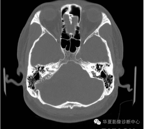 【病例】乳头状内淋巴囊腺瘤1例CT影像表现 【病例】乳头状内淋巴囊腺瘤1例CT影像表现