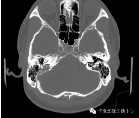 【病例】乳头状内淋巴囊腺瘤1例CT影像表现 【病例】乳头状内淋巴囊腺瘤1例CT影像表现