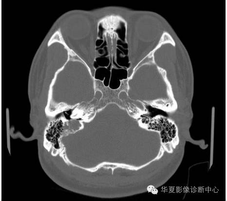 【病例】乳头状内淋巴囊腺瘤1例CT影像表现 【病例】乳头状内淋巴囊腺瘤1例CT影像表现