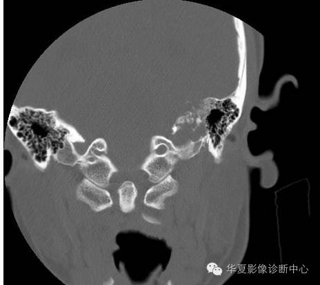 【病例】乳头状内淋巴囊腺瘤1例CT影像表现 【病例】乳头状内淋巴囊腺瘤1例CT影像表现