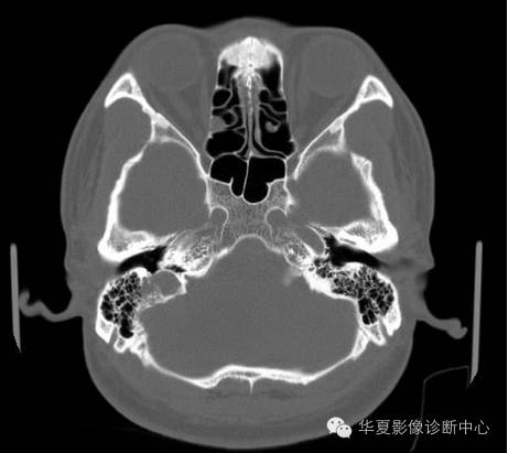 【病例】乳头状内淋巴囊腺瘤1例CT影像表现 【病例】乳头状内淋巴囊腺瘤1例CT影像表现