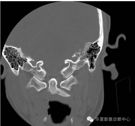 【病例】乳头状内淋巴囊腺瘤1例CT影像表现 【病例】乳头状内淋巴囊腺瘤1例CT影像表现
