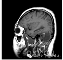 【病例】乳头状内淋巴囊腺瘤1例CT影像表现 【病例】乳头状内淋巴囊腺瘤1例CT影像表现
