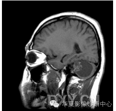 【病例】乳头状内淋巴囊腺瘤1例CT影像表现 【病例】乳头状内淋巴囊腺瘤1例CT影像表现