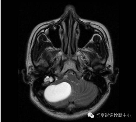 【病例】乳头状内淋巴囊腺瘤1例CT影像表现 【病例】乳头状内淋巴囊腺瘤1例CT影像表现