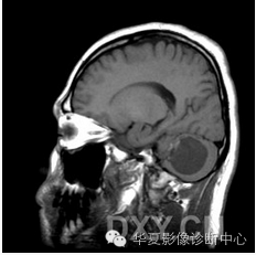 【病例】乳头状内淋巴囊腺瘤1例CT影像表现 【病例】乳头状内淋巴囊腺瘤1例CT影像表现