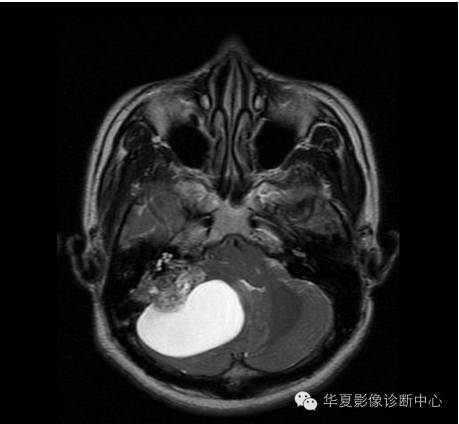 【病例】乳头状内淋巴囊腺瘤1例CT影像表现 【病例】乳头状内淋巴囊腺瘤1例CT影像表现