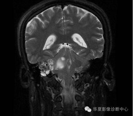 【病例】乳头状内淋巴囊腺瘤1例CT影像表现 【病例】乳头状内淋巴囊腺瘤1例CT影像表现