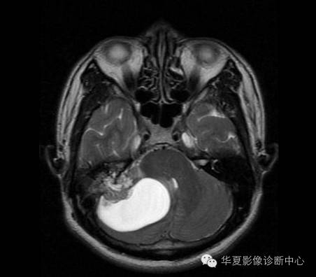 【病例】乳头状内淋巴囊腺瘤1例CT影像表现