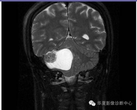 【病例】乳头状内淋巴囊腺瘤1例CT影像表现 【病例】乳头状内淋巴囊腺瘤1例CT影像表现