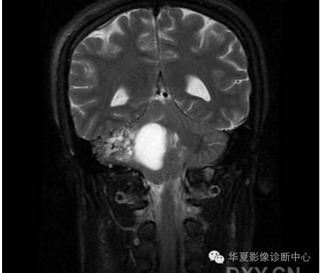 【病例】乳头状内淋巴囊腺瘤1例CT影像表现 【病例】乳头状内淋巴囊腺瘤1例CT影像表现