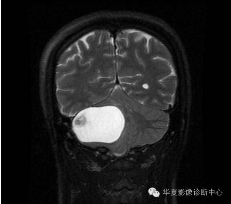 【病例】乳头状内淋巴囊腺瘤1例CT影像表现 【病例】乳头状内淋巴囊腺瘤1例CT影像表现