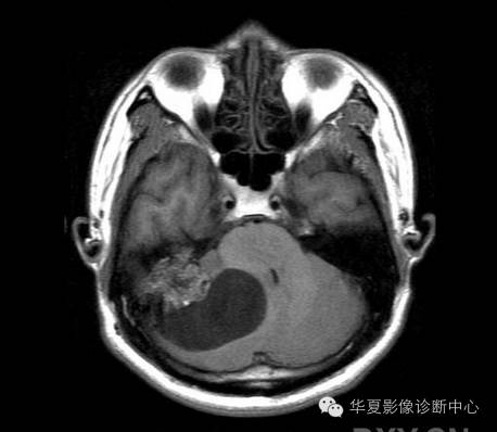 【病例】乳头状内淋巴囊腺瘤1例CT影像表现 【病例】乳头状内淋巴囊腺瘤1例CT影像表现