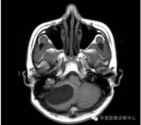 【病例】乳头状内淋巴囊腺瘤1例CT影像表现 【病例】乳头状内淋巴囊腺瘤1例CT影像表现