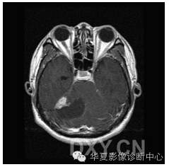 【病例】乳头状内淋巴囊腺瘤1例CT影像表现 【病例】乳头状内淋巴囊腺瘤1例CT影像表现