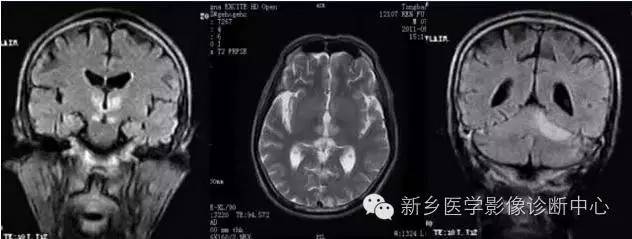 基底动脉综合征