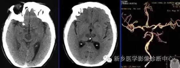 基底动脉综合征 基底动脉综合征