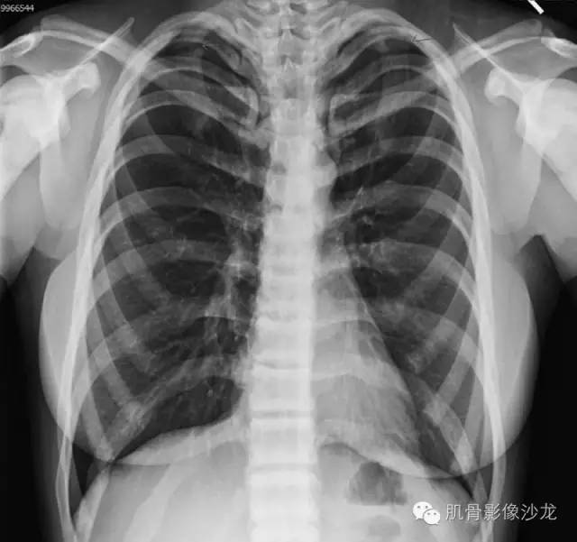 【病例】骨关节典型X线病例读片 【病例】骨关节典型X线病例读片