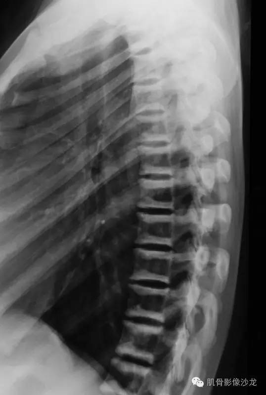 【病例】骨关节典型X线病例读片 【病例】骨关节典型X线病例读片
