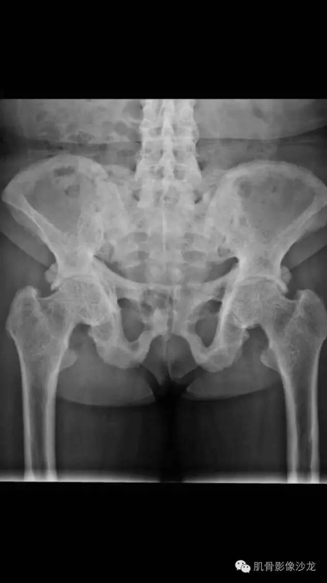 【病例】骨关节典型X线病例读片 【病例】骨关节典型X线病例读片