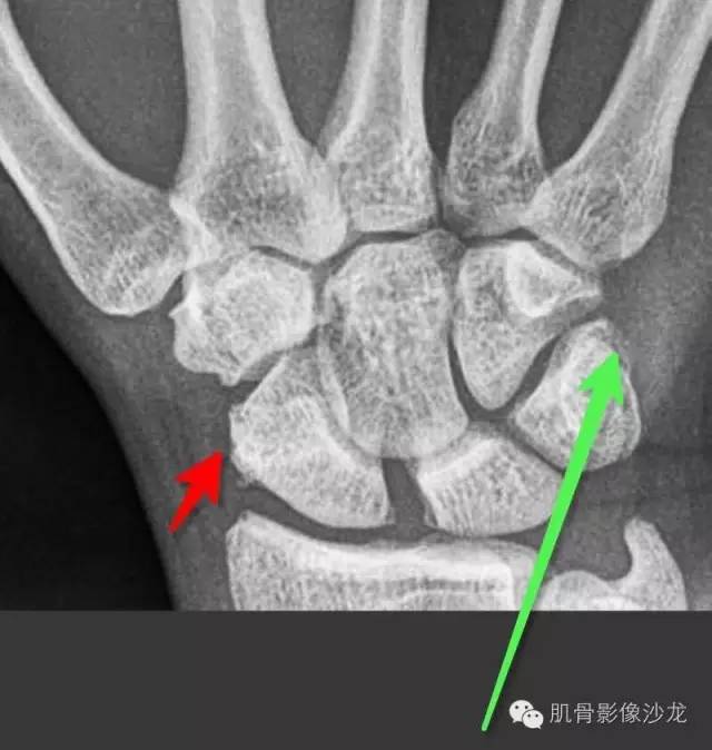 【病例】骨关节典型X线病例读片 【病例】骨关节典型X线病例读片