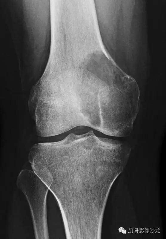 【病例】骨关节典型X线病例读片 【病例】骨关节典型X线病例读片