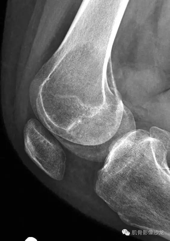 【病例】骨关节典型X线病例读片 【病例】骨关节典型X线病例读片