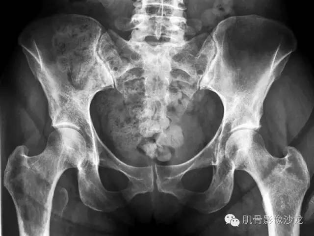 【病例】骨关节典型X线病例读片 【病例】骨关节典型X线病例读片