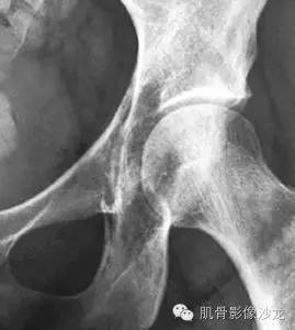 【病例】骨关节典型X线病例读片 【病例】骨关节典型X线病例读片