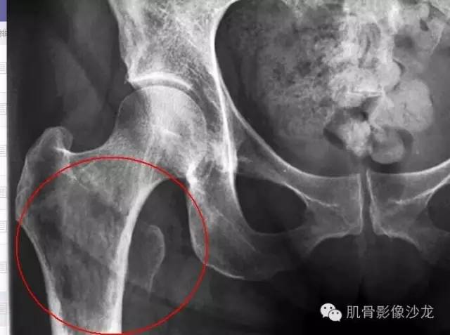 【病例】骨关节典型X线病例读片 【病例】骨关节典型X线病例读片