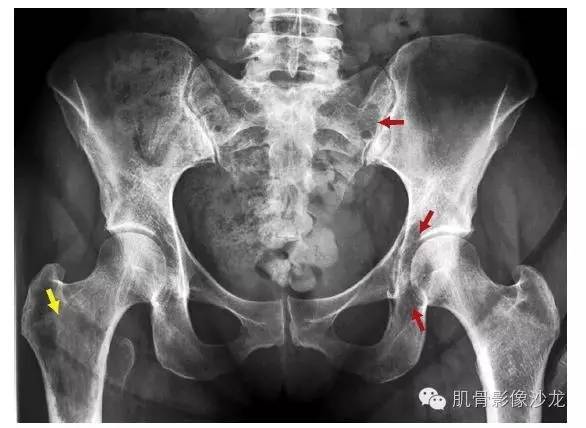【病例】骨关节典型X线病例读片 【病例】骨关节典型X线病例读片