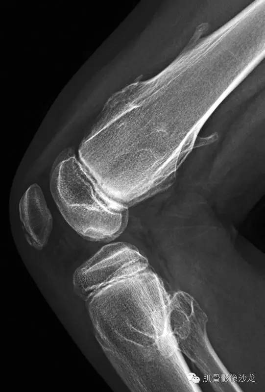 【病例】骨关节典型X线病例读片 【病例】骨关节典型X线病例读片