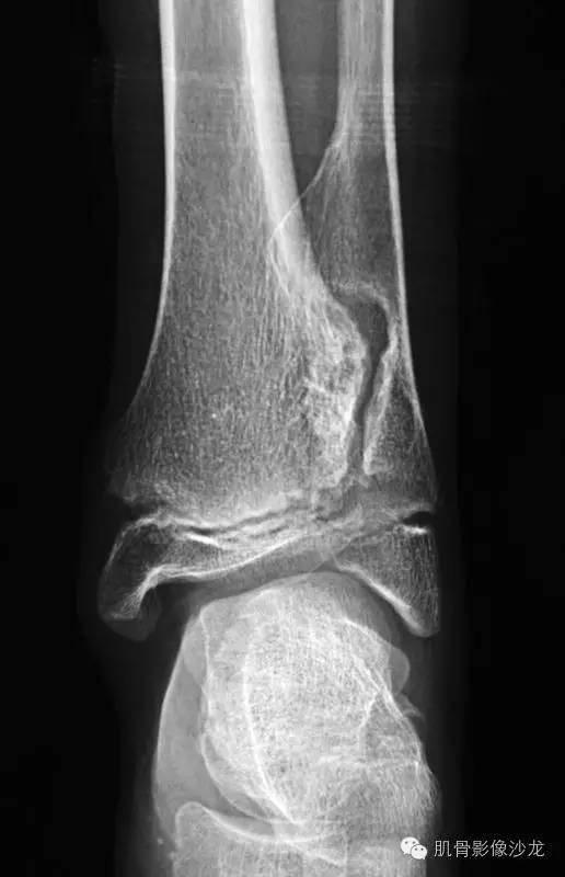 【病例】骨关节典型X线病例读片 【病例】骨关节典型X线病例读片