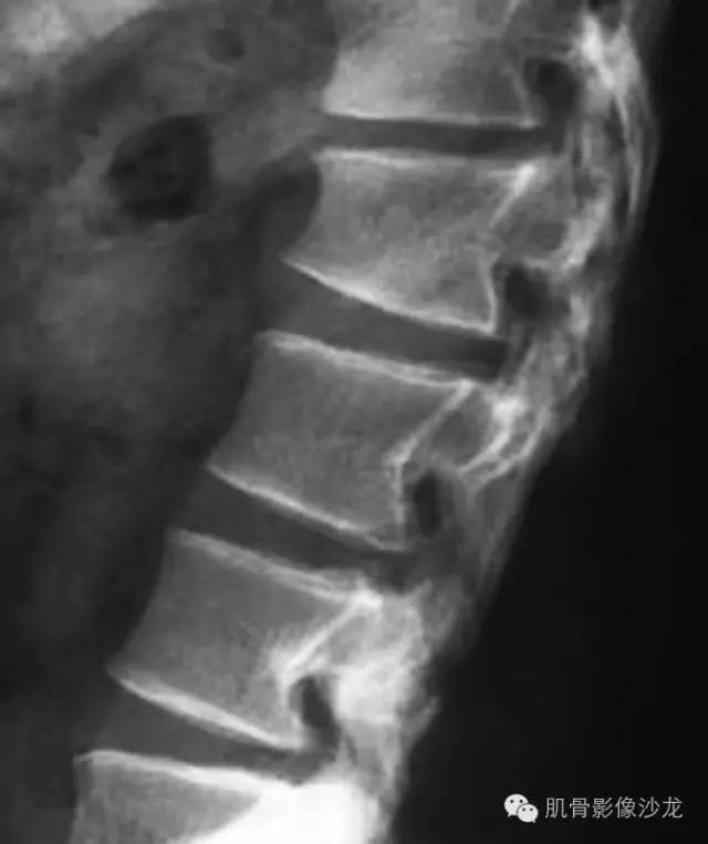 【病例】骨关节典型X线病例读片 【病例】骨关节典型X线病例读片