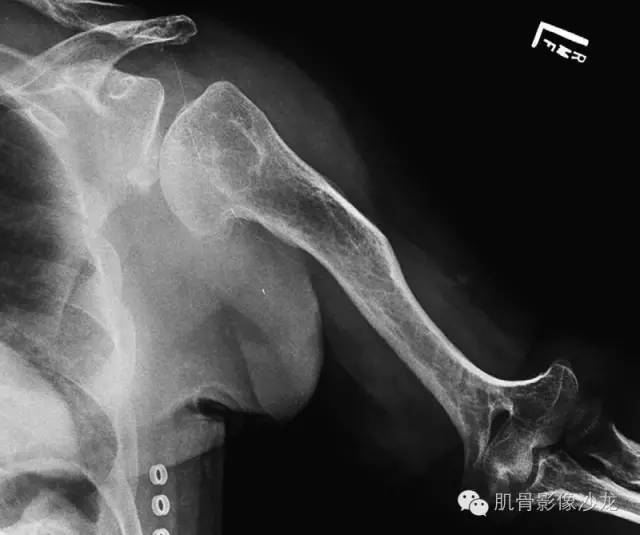 【病例】骨关节典型X线病例读片 【病例】骨关节典型X线病例读片