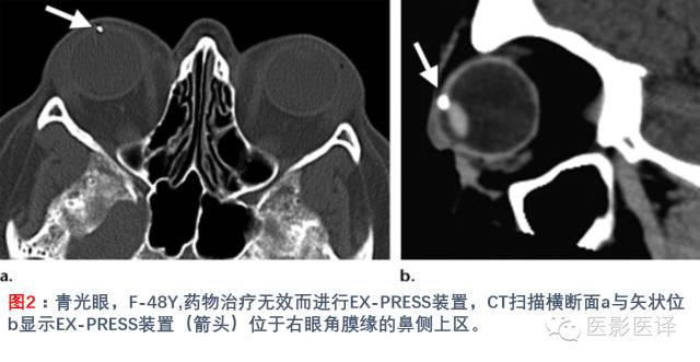 眼眶内容物术后影像学表现