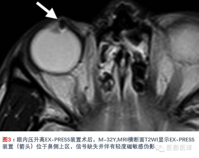眼眶内容物术后影像学表现 眼眶内容物术后影像学表现