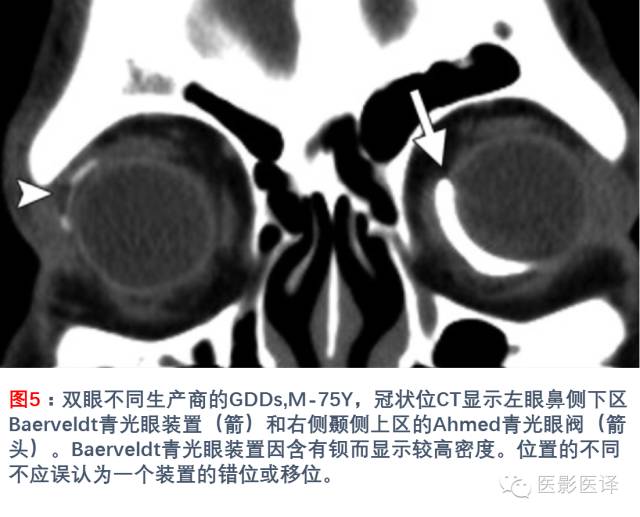 眼眶内容物术后影像学表现 眼眶内容物术后影像学表现